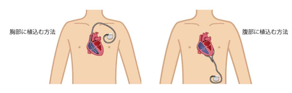 脱毛施術が受けられない病気やケース