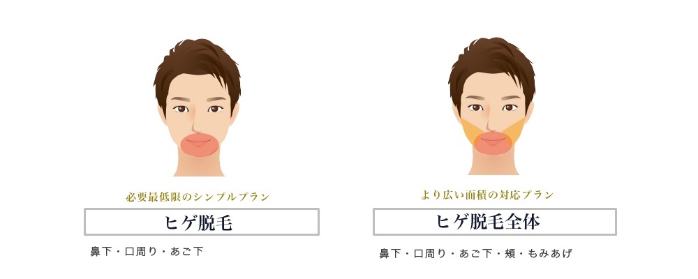 ヒゲ脱毛